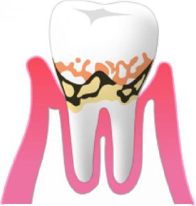 歯周病は、骨が溶ける病気！？